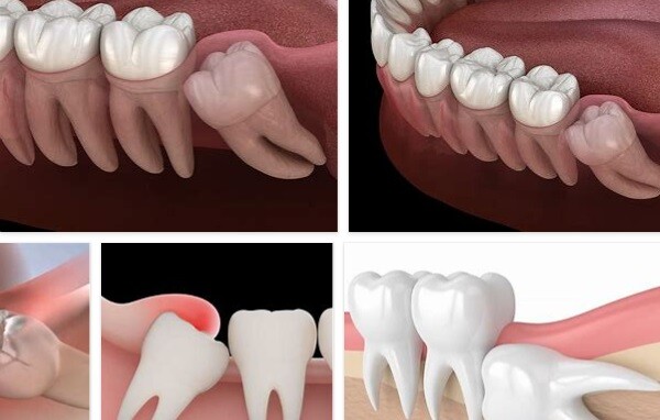 Benefits of Wisdom Teeth Removal